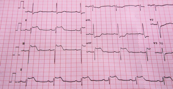 ЕКГ - STEMI - признаци на ST елевация и инфаркт на сърдечния мускул