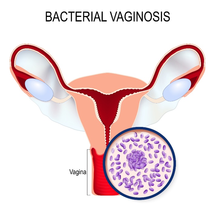 Бактериална вагиноза и свръхрастеж на Gardnerella vaginalis