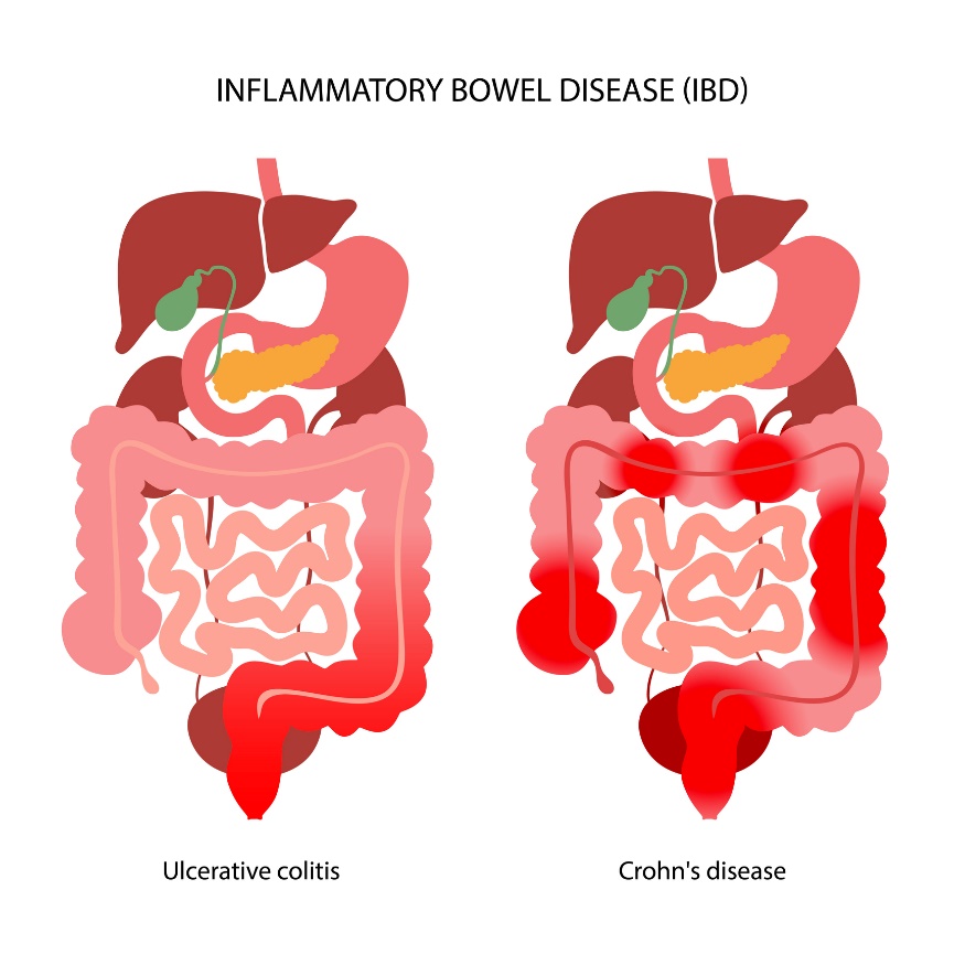 IBD: Разделяне на улцерозен колит и болест на Крон в зависимост от локализацията на възпалителната реакция.