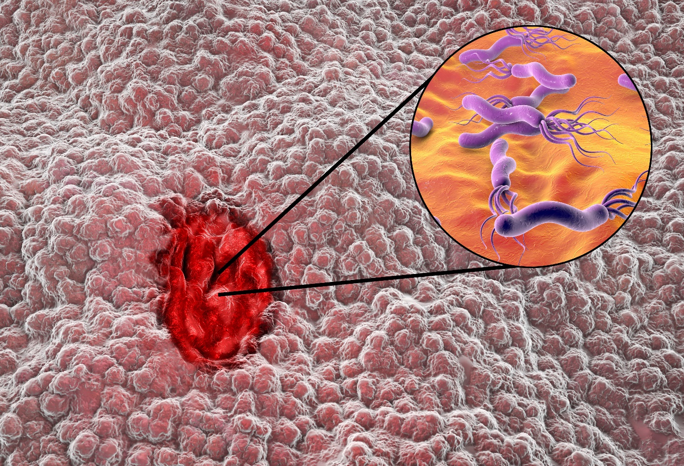 Инфекция с Helicobacter pylori