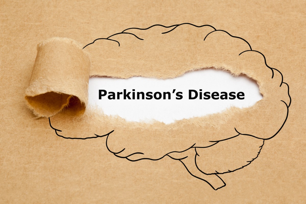 Morbus parkinson = болест на Паркинсон = болест на Паркинсон - анимация на мозък с болест на Паркинсон в средата