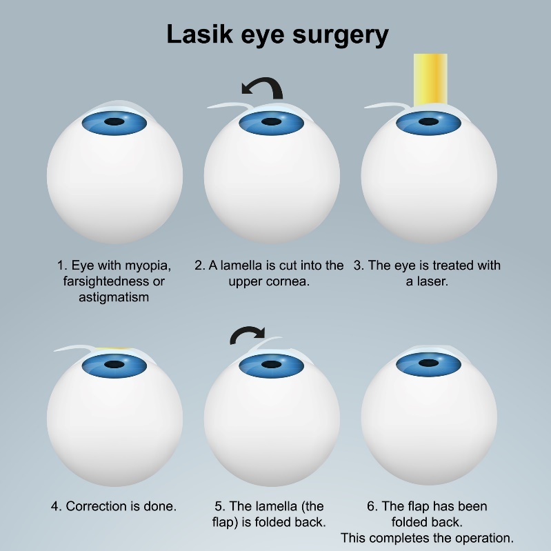 Лазерна хирургия на очите LASIK - подповърхностен метод. Процедура с ламел/ламел без увреждане на нервните окончания.