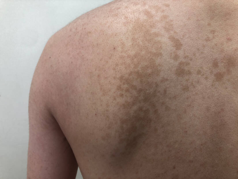 Pityriasis versicolor: Какво представлява и какви симптоми има? Причини и предаване